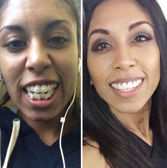 صور مدهشة لأشخاص قبل وبعد استخدام تقويم الأسنان صورة رقم 10