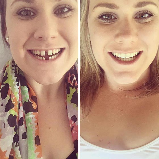 صور مدهشة لأشخاص قبل وبعد استخدام تقويم الأسنان صورة رقم 11