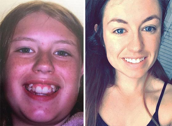 صور مدهشة لأشخاص قبل وبعد استخدام تقويم الأسنان صورة رقم 12