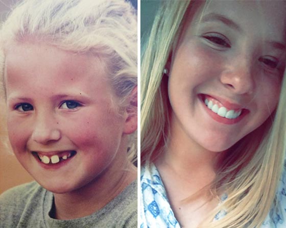 صور مدهشة لأشخاص قبل وبعد استخدام تقويم الأسنان صورة رقم 16