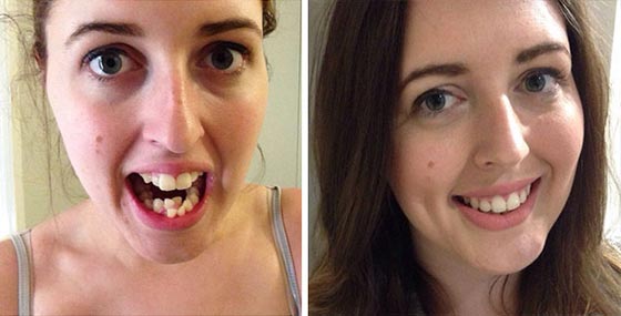 صور مدهشة لأشخاص قبل وبعد استخدام تقويم الأسنان صورة رقم 17