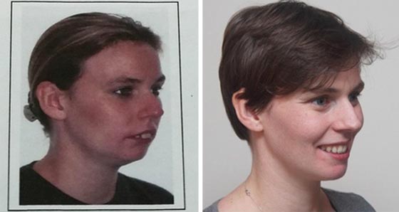 صور مدهشة لأشخاص قبل وبعد استخدام تقويم الأسنان صورة رقم 18
