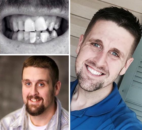 صور مدهشة لأشخاص قبل وبعد استخدام تقويم الأسنان صورة رقم 19