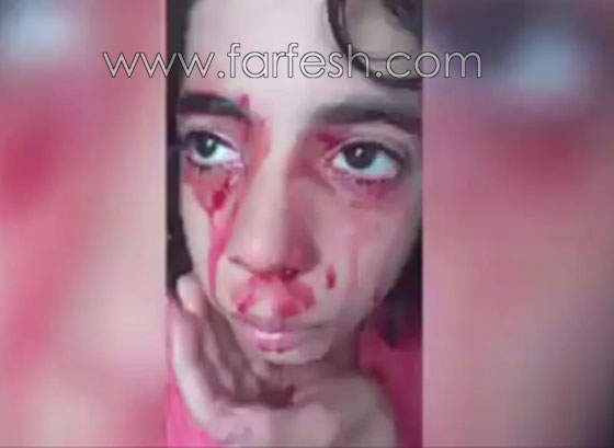 فيديو مؤلم.. طفلة مغربية تنزف دما من كل جسدها صورة رقم 1