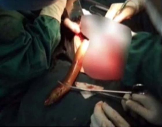بالفيديو والصور.. استخراج ثعبان بحر من بطن رجل صيني وهو بحالة سكر! صورة رقم 2