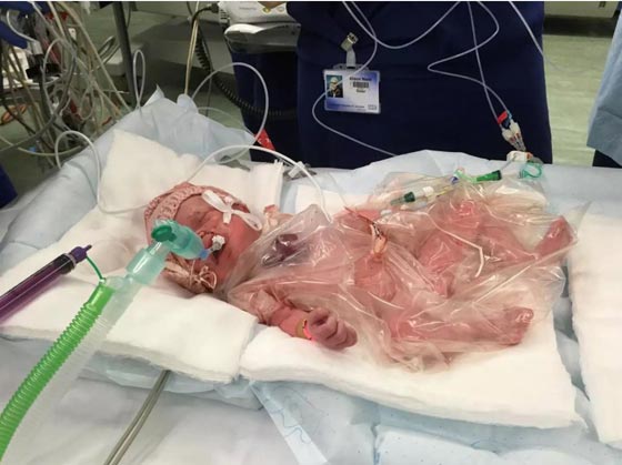 جراحة نادرة لرضيعة وُلدت بقلب خارج جسمها.. صور صورة رقم 2