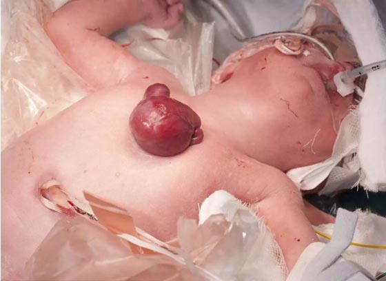 جراحة نادرة لرضيعة وُلدت بقلب خارج جسمها.. صور صورة رقم 1