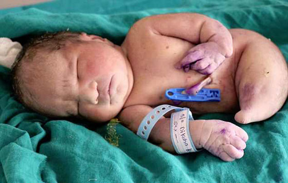 الصور: هندية تنجب (حورية بحر) والمولود يموت بعد 15 دقيقة! صورة رقم 2