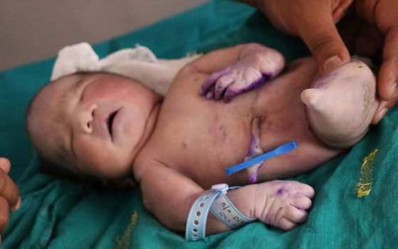 الصور: هندية تنجب (حورية بحر) والمولود يموت بعد 15 دقيقة! صورة رقم 1