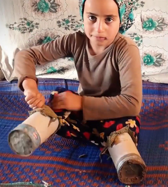 فيديو مبكي: طفلة سورية مبتورة القدمين تنتعل علب معدنية كأطراف! صورة رقم 3