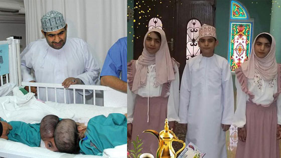 صور  التوأم السيامي العماني صفا ومروة بعد 11 عاما من عملية الفصل  بأمر ملك السعودية صورة رقم 1
