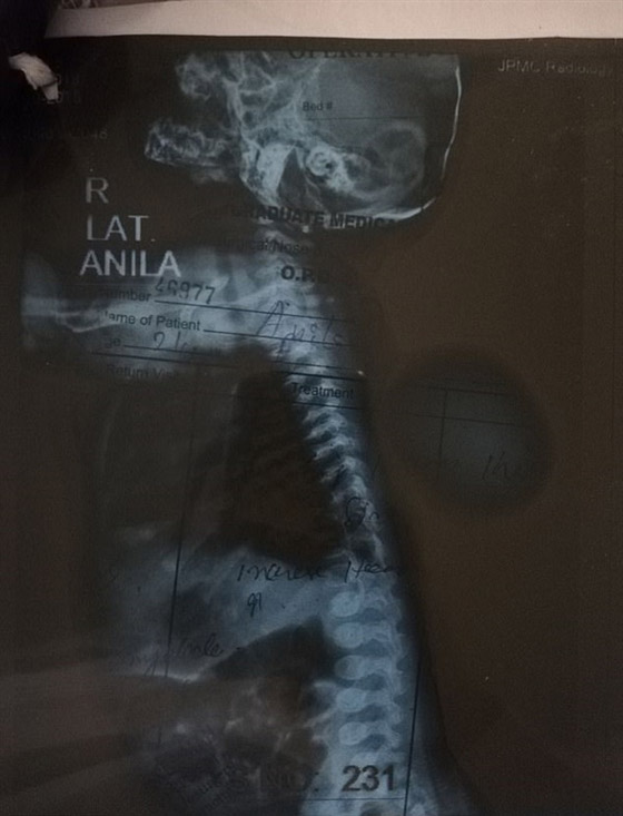 حالة نادرة: مخ طفلة باكستانية خارج جمجمتها صورة رقم 2
