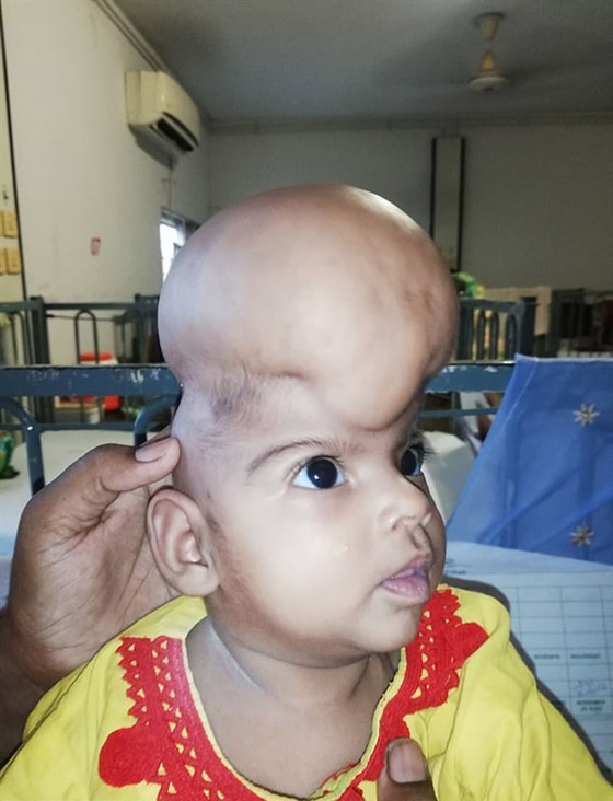 حالة نادرة: مخ طفلة باكستانية خارج جمجمتها صورة رقم 3