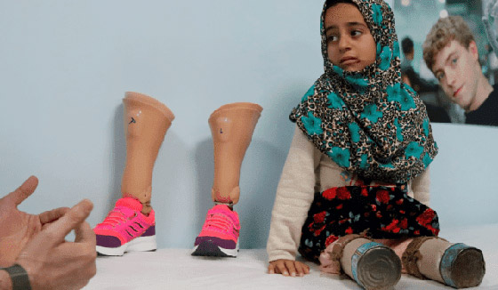 طفلة سورية تستبدل المعلبات الفارغة بأطراف اصطناعية.. اليكم قصتها صورة رقم 1