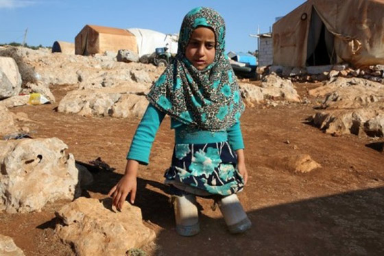 طفلة سورية تستبدل المعلبات الفارغة بأطراف اصطناعية.. اليكم قصتها صورة رقم 7