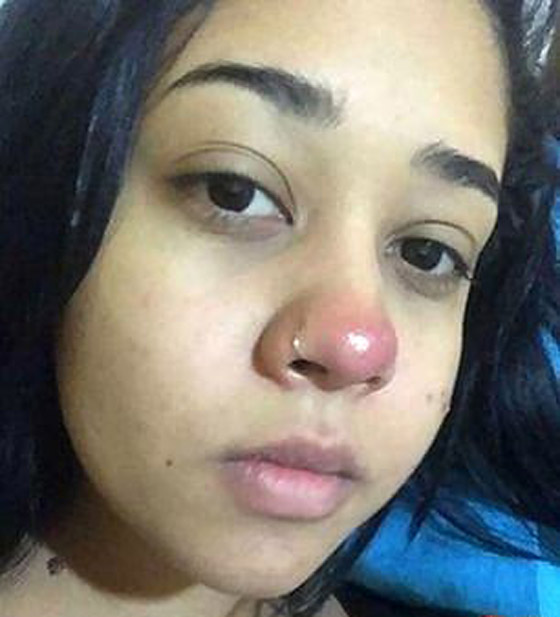 فتاة برازيلية تصاب بالشلل التام بسبب ثقب في الأنف صورة رقم 1