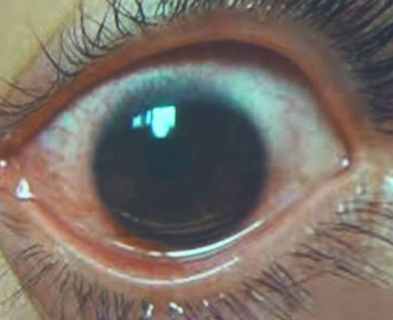 فيديو وصور: سيدة تصاب بـ500 ثقب في قرنية عينها بسبب الموبايل صورة رقم 6