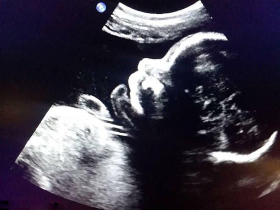 لأول مرة في العالم: رجل حامل يضع أول أطفاله! فيديو وصور صورة رقم 8