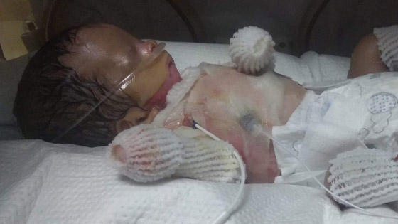 حالة طبية نادرة: طفل يولد بدون جلد يغطي جسمه! صورة رقم 3