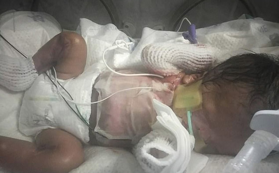 حالة طبية نادرة: طفل يولد بدون جلد يغطي جسمه! صورة رقم 6