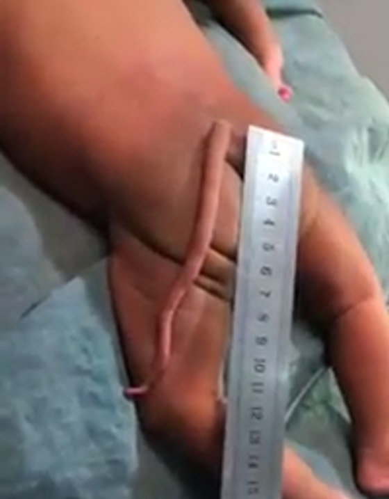 ظاهرة نادرة وصادمة: ولادة طفلة بذيل أسفل الظهر! فيديو وصور صورة رقم 7