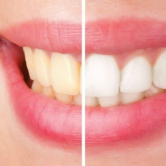 طرق طبيعية للتخلّص من اصفرار الأسنان صورة رقم 4
