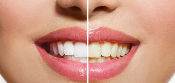 طرق طبيعية للتخلّص من اصفرار الأسنان صورة رقم 2