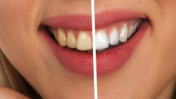 طرق طبيعية للتخلّص من اصفرار الأسنان صورة رقم 3