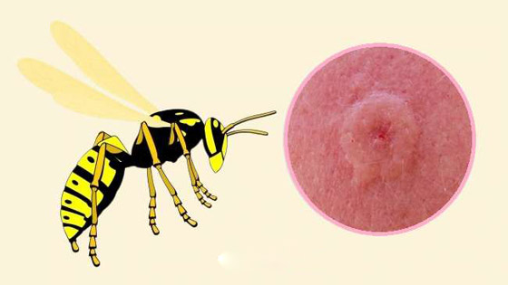 البعوض.. وأشهر الحشرات اللادغة وأعراض الإصابة صورة رقم 3