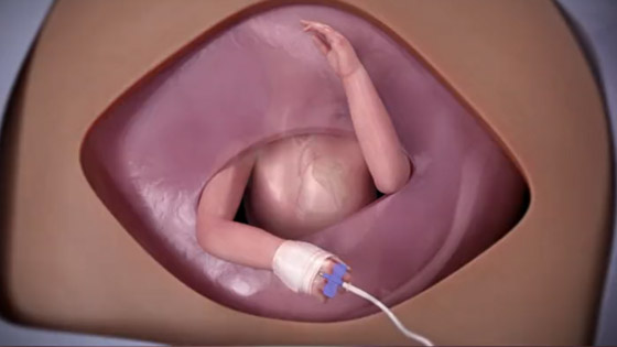 فيديو مدهش.. جراحة لجنين داخل بطن أمه على يد طبيب سعودي صورة رقم 2
