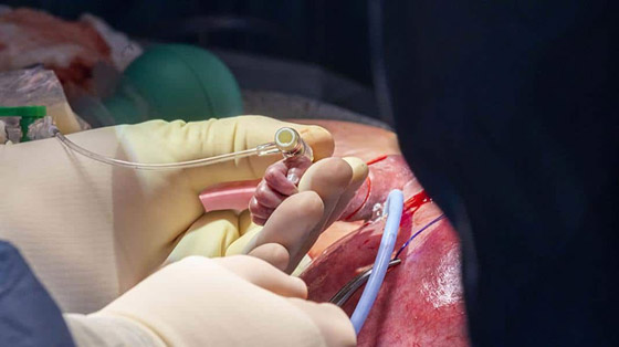 فيديو مدهش.. جراحة لجنين داخل بطن أمه على يد طبيب سعودي صورة رقم 4