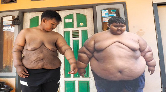 أثقل طفل في العالم يخسر 120 كيلوغراماً من وزنه صورة رقم 3