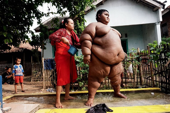 أثقل طفل في العالم يخسر 120 كيلوغراماً من وزنه صورة رقم 6