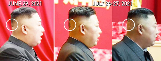 كدمة داكنة وضمادة.. رأس زعيم كوريا الشمالية كيم يثير الحيرة والمخاوف! صورة رقم 2