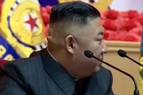 كدمة داكنة وضمادة.. رأس زعيم كوريا الشمالية كيم يثير الحيرة والمخاوف! صورة رقم 4