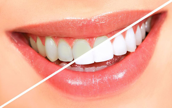 إليكم 4 طرق منزلية فعالة لتبييض الأسنان صورة رقم 1