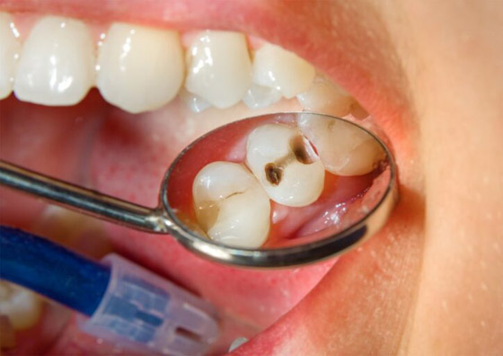  صورة رقم 1 - تجنبوها للحفاظ على أسنانكم.. إليكم 7 عوامل تزيد من التسوس