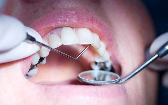  صورة رقم 2 - تجنبوها للحفاظ على أسنانكم.. إليكم 7 عوامل تزيد من التسوس