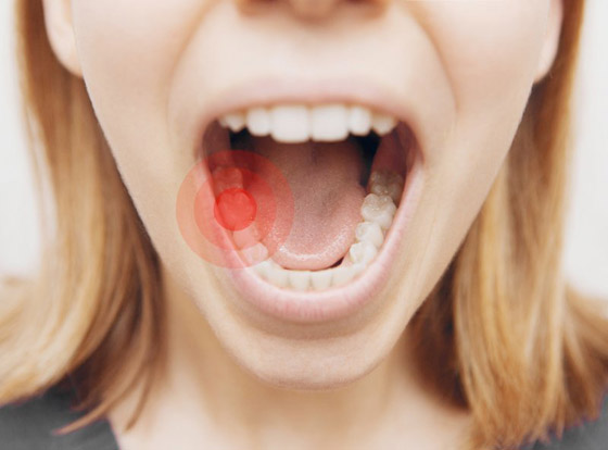  صورة رقم 3 - تجنبوها للحفاظ على أسنانكم.. إليكم 7 عوامل تزيد من التسوس