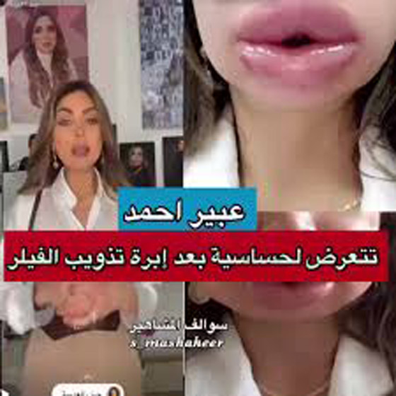 فيديو صادم وتحذير: فنانة مصرية تكشف كيف تشوه وجهها بعد عملية تجميل!  صورة رقم 6
