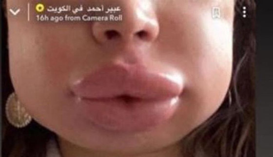 فيديو صادم وتحذير: فنانة مصرية تكشف كيف تشوه وجهها بعد عملية تجميل!  صورة رقم 1