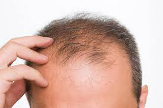  صورة رقم 5 - لعلاج تساقط الشعر.. إليك 7 طرق طبيعية فعالة