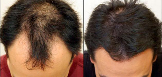  صورة رقم 7 - لعلاج تساقط الشعر.. إليك 7 طرق طبيعية فعالة