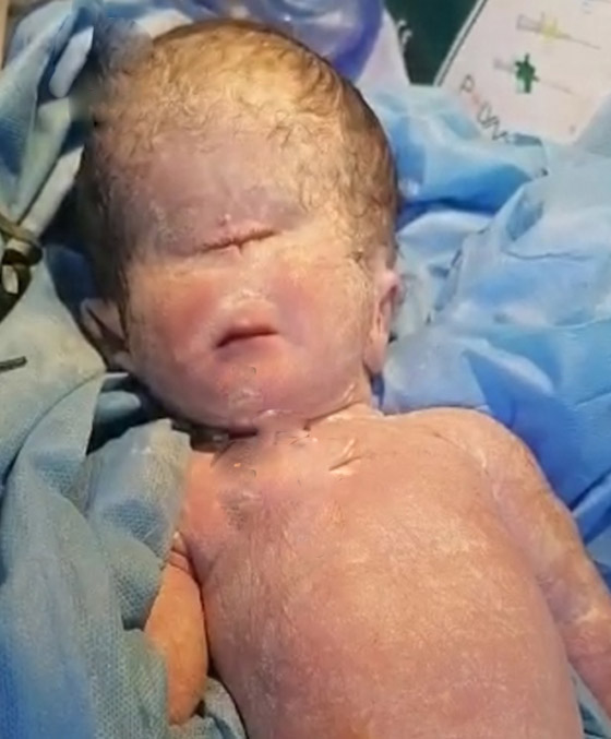 صور صادمة لولادة طفل بعين واحدة في العراق.. والطب يوضح صورة رقم 3