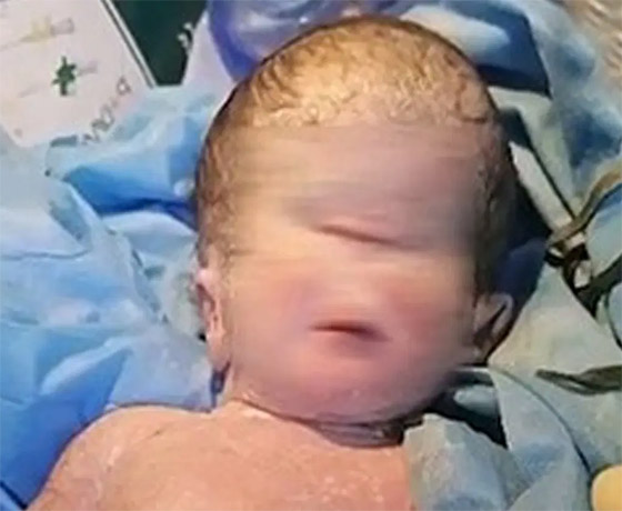 صور صادمة لولادة طفل بعين واحدة في العراق.. والطب يوضح صورة رقم 1