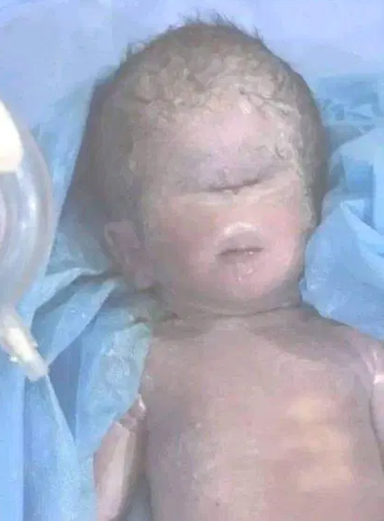 صور صادمة لولادة طفل بعين واحدة في العراق.. والطب يوضح صورة رقم 2