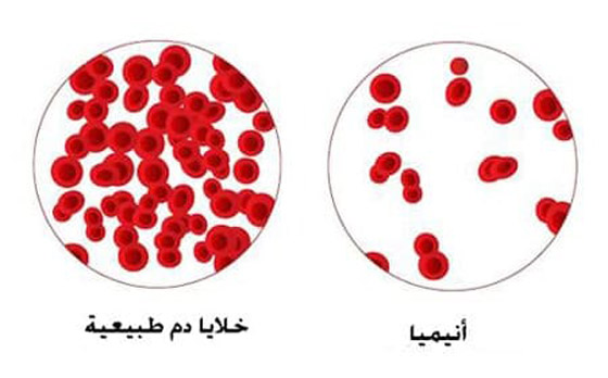  صورة رقم 2 - مش الأكل بس.. تعرف على أمراض تسبب فقر الدم والأنيميا