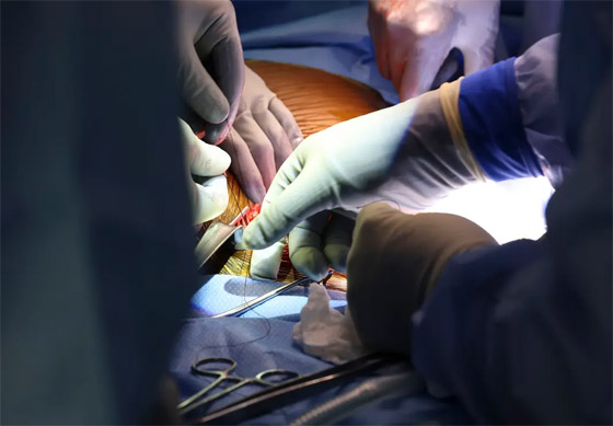 فيديو: جراحون أمريكيون يزرعون كلية خنزير معدل وراثيا لمريض حي صورة رقم 6