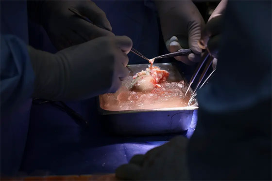 فيديو: جراحون أمريكيون يزرعون كلية خنزير معدل وراثيا لمريض حي صورة رقم 12