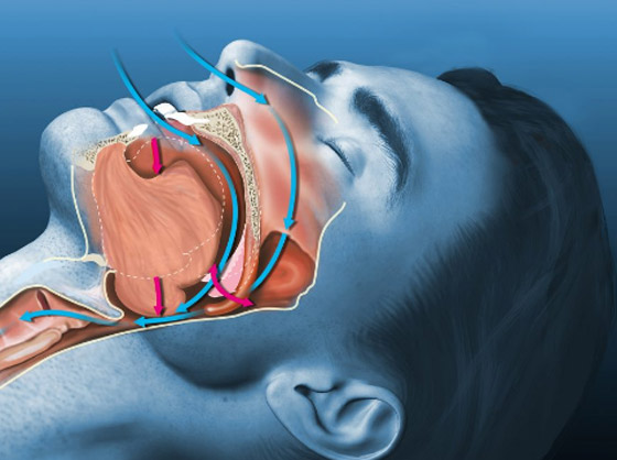 لانقطاع التنفس أثناء النوم.. عقار جديد يقلل من شدة المرض صورة رقم 1